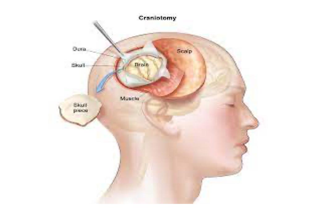 Brain Tumor Surgery